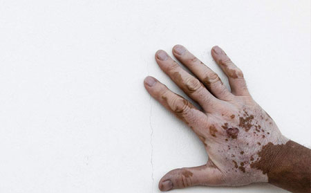 白癜風(fēng)發(fā)病原因,引起白癜風(fēng)的病因