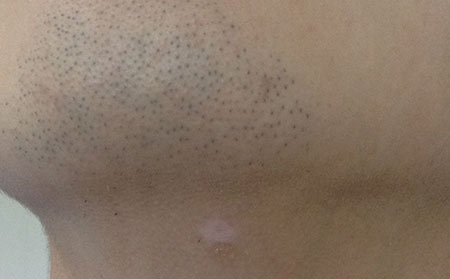 白癜風(fēng)發(fā)病人群,什么人容易得白癜風(fēng)