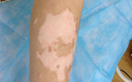 白癜風發(fā)病原因,白癜風的形成原因