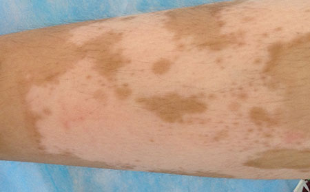 身上出現(xiàn)白點(diǎn)是白癜風(fēng)嗎