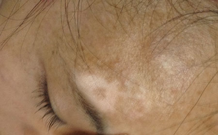 白癜風(fēng)發(fā)病人群,嬰兒白癜風(fēng)