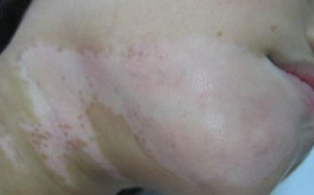 識別白癜風的方法,判斷白癜風方法,鑒別白癜風方法