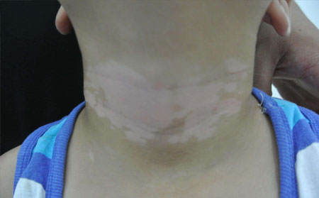 診斷白癜風(fēng),進(jìn)展期白癜風(fēng)