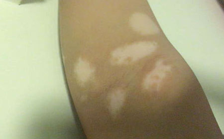 預(yù)防白癜風(fēng),預(yù)防局限型白癜風(fēng)