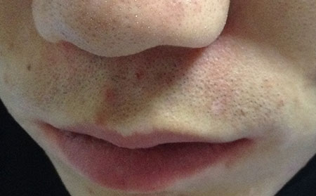 預(yù)防白癜風(fēng),預(yù)防泛發(fā)型白癜風(fēng)