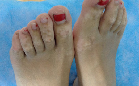 白癜風(fēng)如何好轉(zhuǎn),白癜風(fēng)好轉(zhuǎn)癥狀圖片,白癜風(fēng)好轉(zhuǎn)判斷