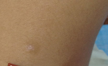 治療白癜風(fēng),輔助治療白癜風(fēng),白癜風(fēng)預(yù)防護理