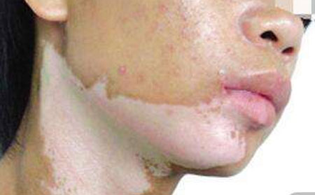 預(yù)防白癜風(fēng),如何預(yù)防白癜風(fēng)