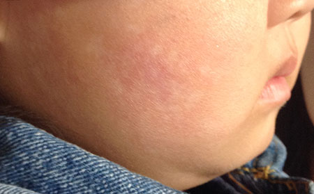 秋季白癜風(fēng)患者需要注意什么呢