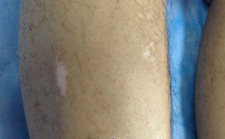 青少年身上出現(xiàn)白癜風了怎么辦