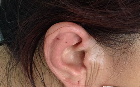 青少年患白癜風(fēng)有什么危害