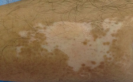 青少年出現(xiàn)白癜風的原因是什么