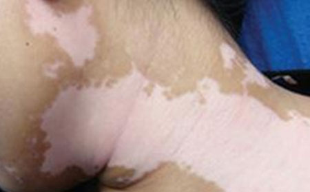 怎樣治療青少年白癜風(fēng)