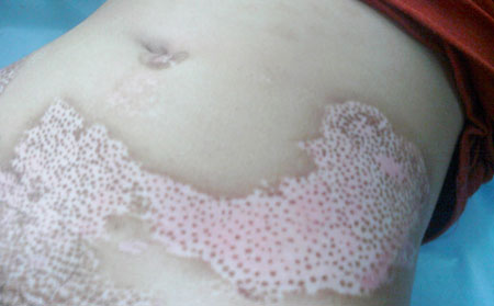 青少年白癜風(fēng)患者的治療優(yōu)勢(shì)