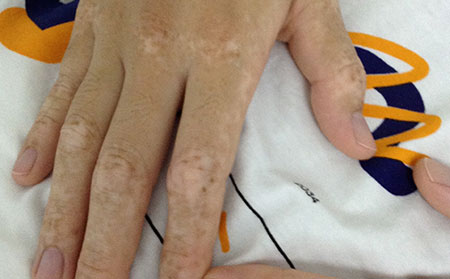 平時怎么護理白癜風(fēng)疾病