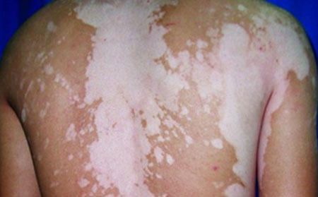 皮膚上起白斑是白癜風(fēng)嗎