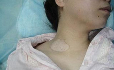 白癜風(fēng)危害,白癜風(fēng)并發(fā)癥