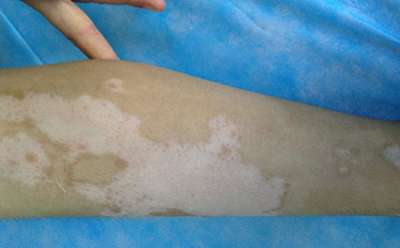 白癜風(fēng)遺傳嗎,白癜風(fēng)到底遺不遺傳