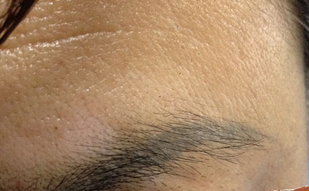 白癜風(fēng)遺傳嗎,白癜風(fēng)的遺傳幾率有多大