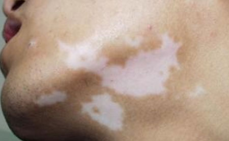 白癜風(fēng)遺傳嗎,白癜風(fēng)具有遺傳性嗎,怎樣預(yù)防白癜風(fēng)的發(fā)生