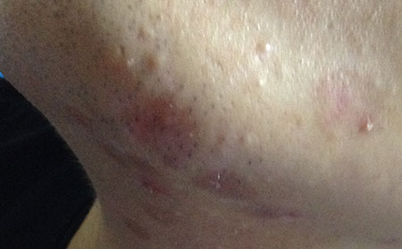 白癜風(fēng)遺傳嗎,避免白癜風(fēng)遺傳有哪些注意事項(xiàng)呢