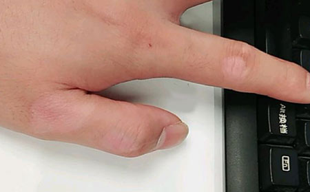 初期白癜風(fēng)會不會遺傳?白癜風(fēng)怎么護(hù)理好呢