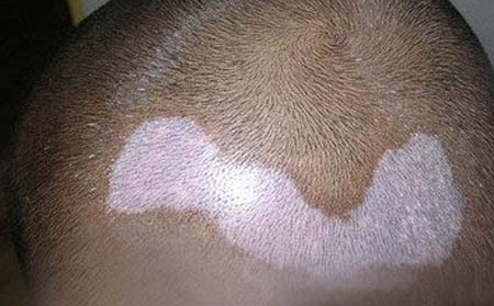 白癜風(fēng)遺傳嗎,老婆有白癜風(fēng)會(huì)不會(huì)以后遺傳給孩子