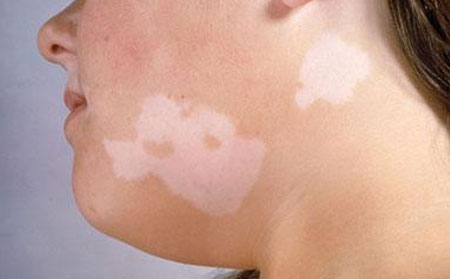 白癜風(fēng)傳染嗎,白癜風(fēng)會不會傳染別人呢