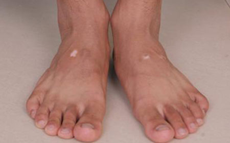 白癜風(fēng)傳染嗎,白癜風(fēng)疾病會(huì)傳染嗎