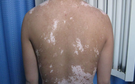 白癜風(fēng)傳染嗎,白癜風(fēng)是不是被傳染的,白癜風(fēng)的誘發(fā)原因