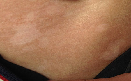 白癜風傳染嗎,白癜風是不是一種傳染病