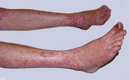 過敏性紫癜危害,得過敏性紫癜危害