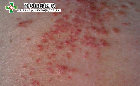 濕疹并發(fā)癥,長期得濕疹并發(fā)癥