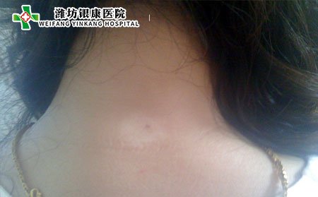 孕婦有白癜風(fēng)怎么辦,孕婦白癜風(fēng)怎么辦