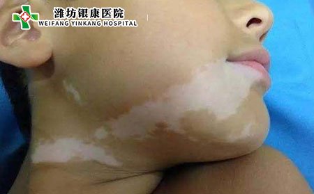 兒童白癜風(fēng)癥狀,兒童白癜風(fēng)什么樣