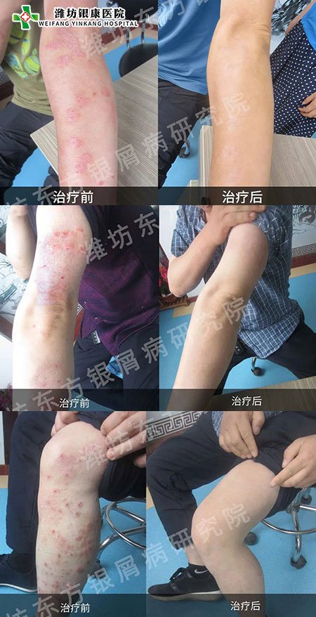 [山東]濰坊銀康醫(yī)院牛皮癬銀屑病治療康復(fù)對比圖