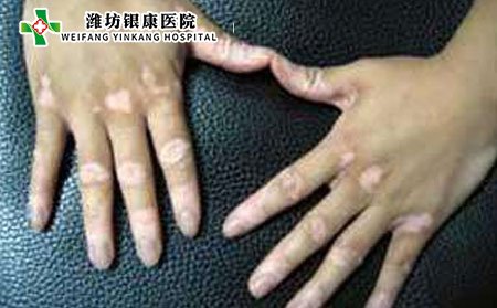 白癜風(fēng)傳染嗎,白癜風(fēng)會不會傳染