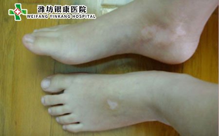 白癜風(fēng)病因,為什么會(huì)得白癜風(fēng)