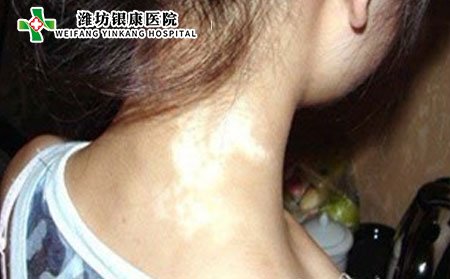 白癜風(fēng)癥狀,初期白癜風(fēng)的癥狀