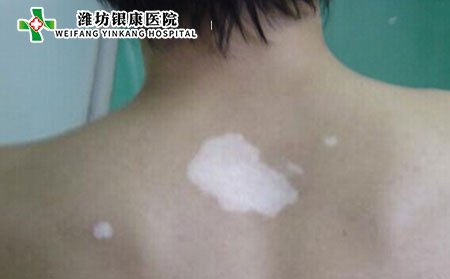 白癜風發(fā)病部位,白癜風長在哪個部位
