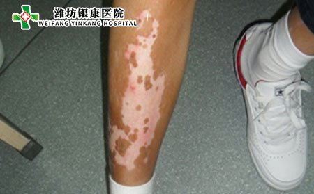 白癜風(fēng)癥狀,腿部白癜風(fēng)癥狀