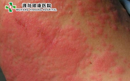 泛發(fā)性濕疹,泛發(fā)性濕疹護(hù)理