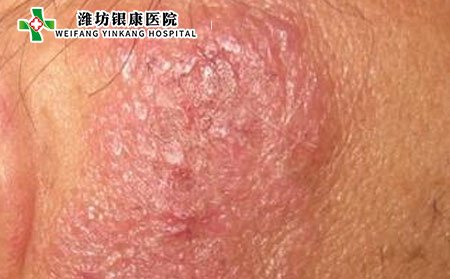 泛發(fā)性濕疹,泛發(fā)性濕疹癥狀,濕疹癥狀