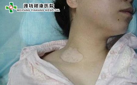 白癜風癥狀,白癜風癥狀表現(xiàn)
