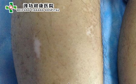 什么是繼發(fā)性白癜風(fēng)?