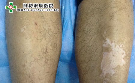 維生素C過(guò)量會(huì)引起白癜風(fēng)嗎?