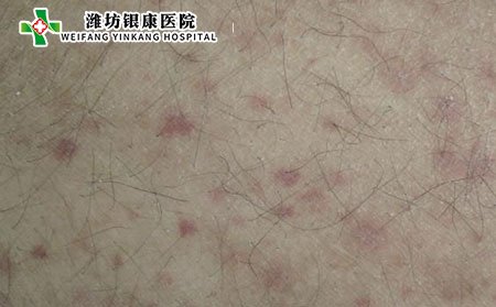 過敏性紫癜吃什么