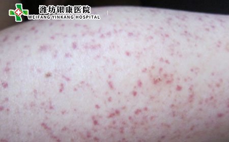 過(guò)敏性有哪幾種類型