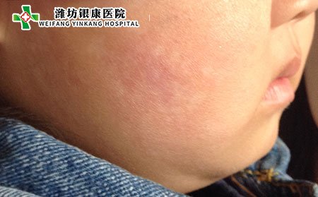 什么是血瘀型白癜風(fēng)?該如何護理?