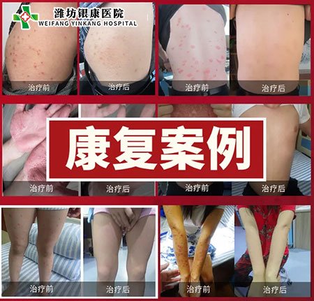 銀屑病皮膚病專家會診康復(fù)案例 銀屑病皮膚病專家會診康復(fù)案例